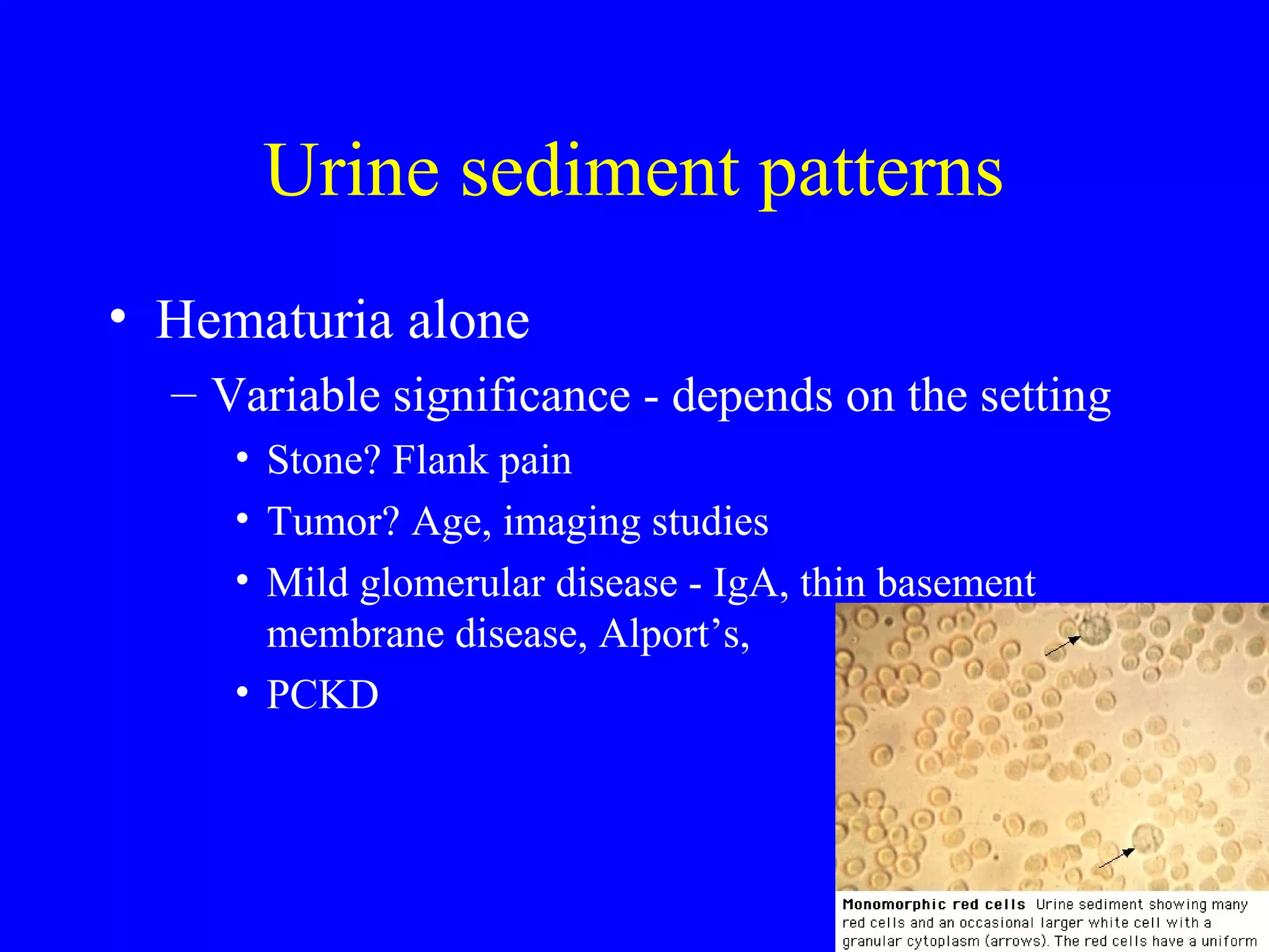 Urine sediment patterns
• Hematuria alone
– Variable significance - depends on the setting
• Stone? Flank pain
• Tumor? Age, imaging studies
• Mild glomerular disease - IgA, thin basement
membrane disease, Alport’s,
• PCKD
 