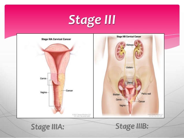 Cervical Cancer 4 College Students