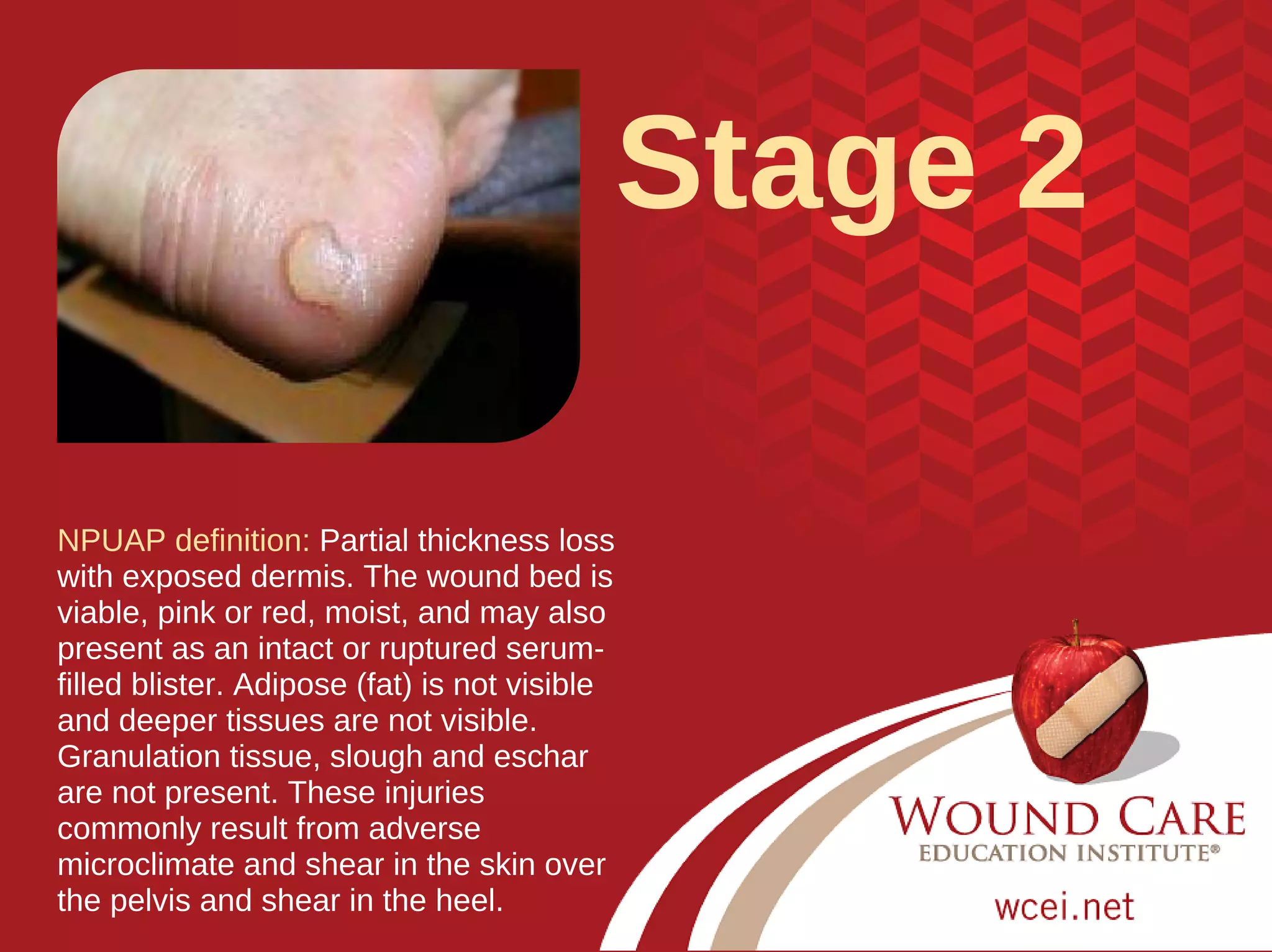 Test Your Pressure Injury Staging Skills - Updated for 2016 | PDF