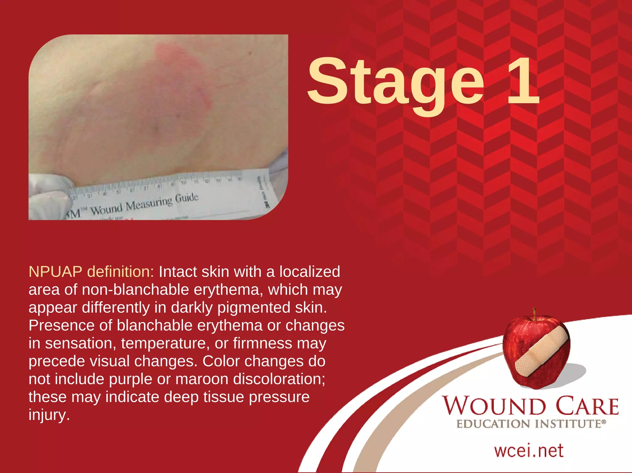 Test Your Pressure Injury Staging Skills Updated For 2016 PDF