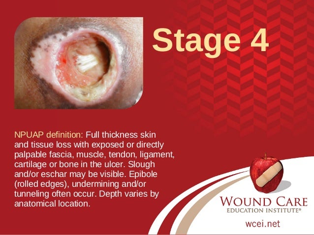 pressure ulcer your test staging skills Skills Test Updated  Pressure Staging 2016 Injury for  Your