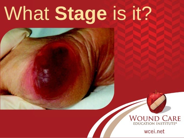 your ulcer skills test staging pressure Test for Injury Updated Skills 2016 Your Pressure Staging your ulcer skills test staging pressure Test for Injury Updated Skills 2016 Your Pressure Staging