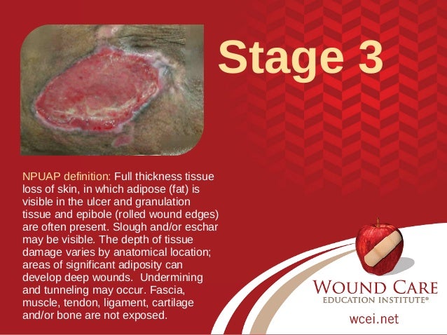 photo Stage 3 Pressure Injury test your pressure injury staging