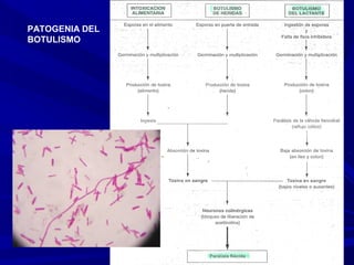 PATOGENIA DEL
BOTULISMO
 