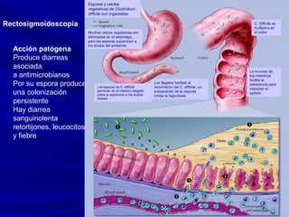 Acción patógena
Produce diarreas
asociada
a antimicrobianos
Por su espora produce
una colonización
persistente
Hay diarrea
sanguinolenta
retortijones, leucocitosis
y fiebre
Rectosigmoidoscopia
Muchas celuas vegetativas son
eliminadas en el estómago,
pero las esporas superviven a
los ácidos del ambiente
La mucosa de
los intestinos
facilita la
adherencia para
colonizar el
epitelio
Las esporas de C. difficile
germinan en el intestino delgado
sobre la exposicion a los acidos
biliares
Los flagelos facilitan el
movimiento del C. difficile, un
polisacárido de la cápsula
inhibe la fagocitosis
Esporas y celulas
vegetativas de Clostridium
difficile son ingestadas
C. Difficile se
multiplica en
el colon
 
