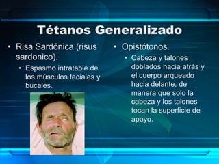Tétanos Generalizado
• Risa Sardónica (risus
sardonico).
• Espasmo intratable de
los músculos faciales y
bucales.
• Opistótonos.
• Cabeza y talones
doblados hacia atrás y
el cuerpo arqueado
hacia delante, de
manera que solo la
cabeza y los talones
tocan la superficie de
apoyo.
 