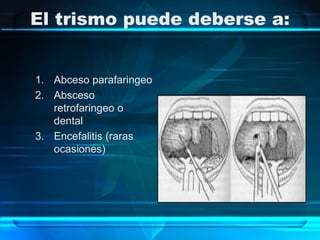 El trismo puede deberse a:
1. Abceso parafaringeo
2. Absceso
retrofaringeo o
dental
3. Encefalitis (raras
ocasiones)
 