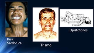 Risa
Sardónica
Trismo
Opistotonos
 
