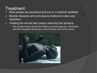 Tetanus Seizing Tetanus | PPTX