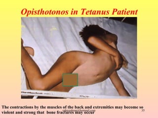Opisthotonos in Tetanus   Patient The contractions by the muscles of the back and extremities may become so violent and st...