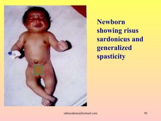 Newborn showing risus sardonicus and generalized spasticity [email_address] 