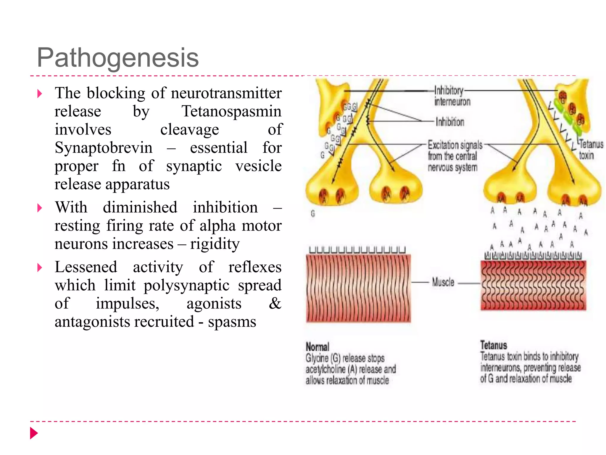 Pathogenesis






The blocking of neurotransmitter
release
by
Tetanospasmin
involves
cleavage
of
Synaptobrevin – essential for
proper fn of synaptic vesicle
release apparatus
With diminished inhibition –
resting firing rate of alpha motor
neurons increases – rigidity
Lessened activity of reflexes
which limit polysynaptic spread
of
impulses,
agonists
&
antagonists recruited - spasms

 