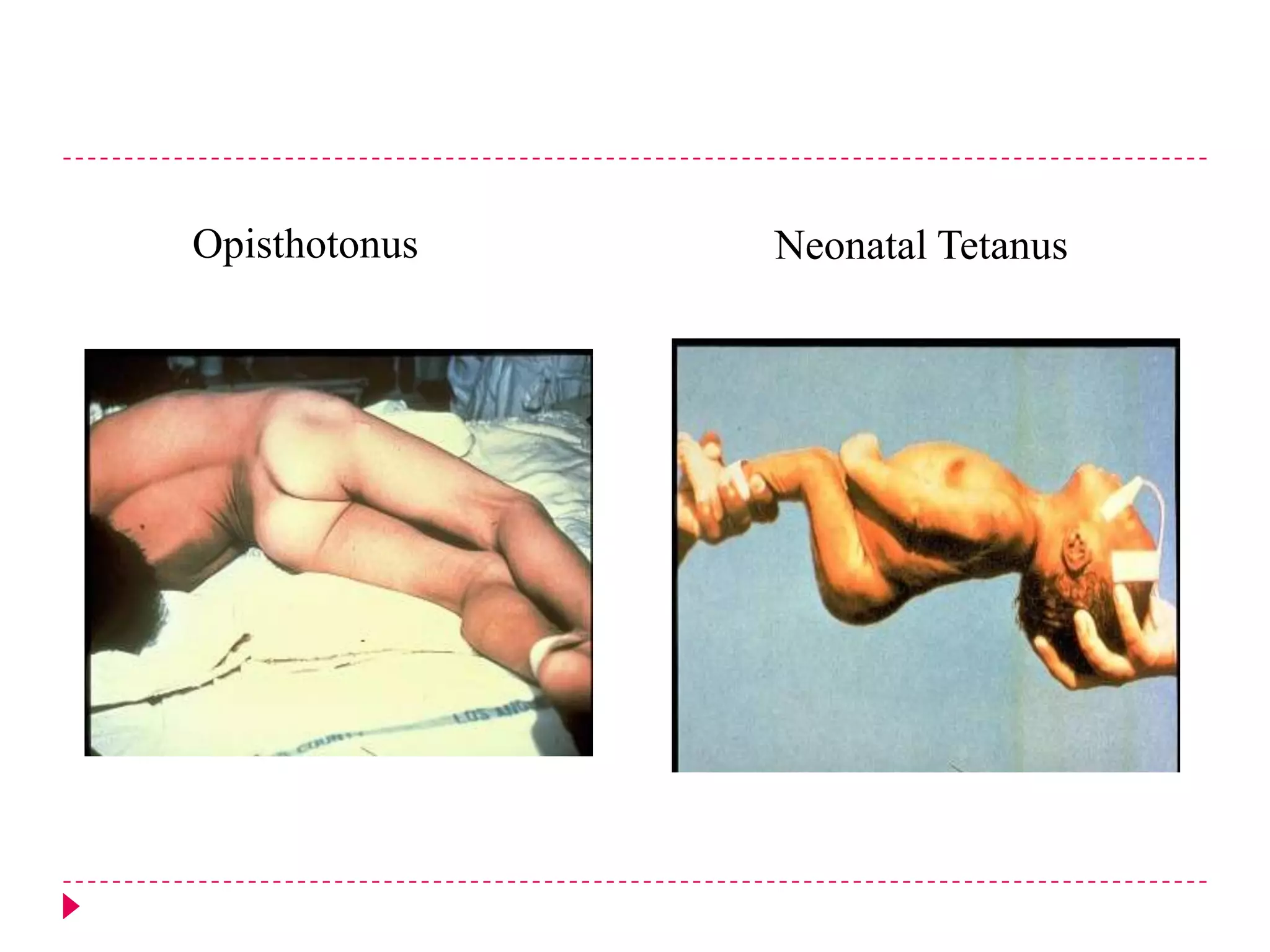 Opisthotonus

Neonatal Tetanus

 