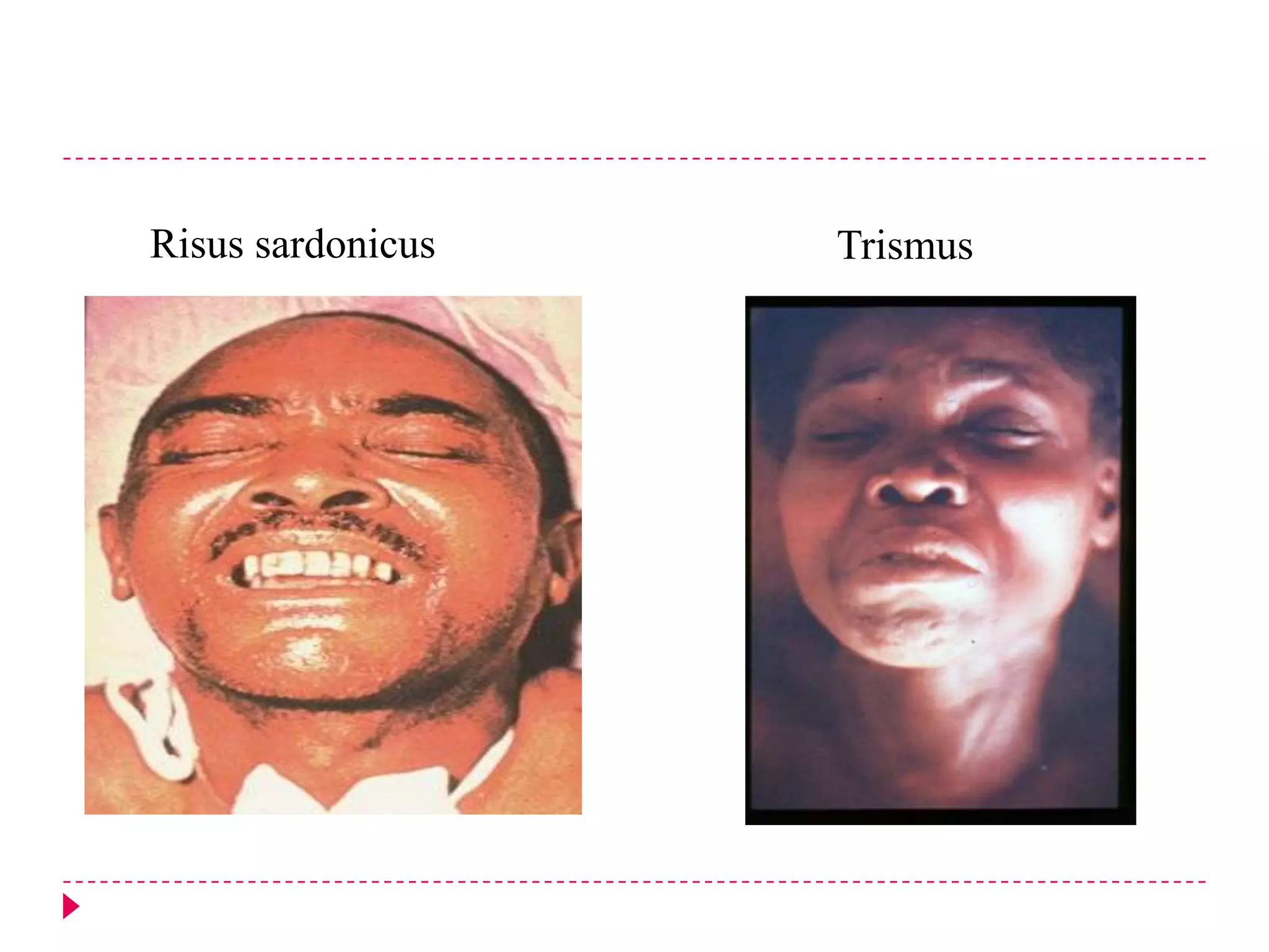 Risus sardonicus

Trismus

 