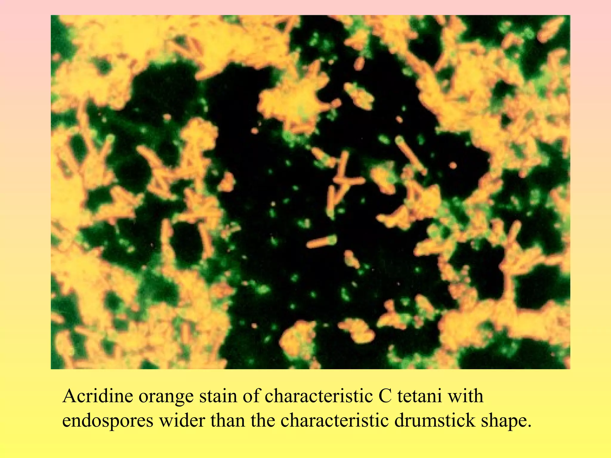 Acridine orange stain of characteristic C tetani with
endospores wider than the characteristic drumstick shape.
 