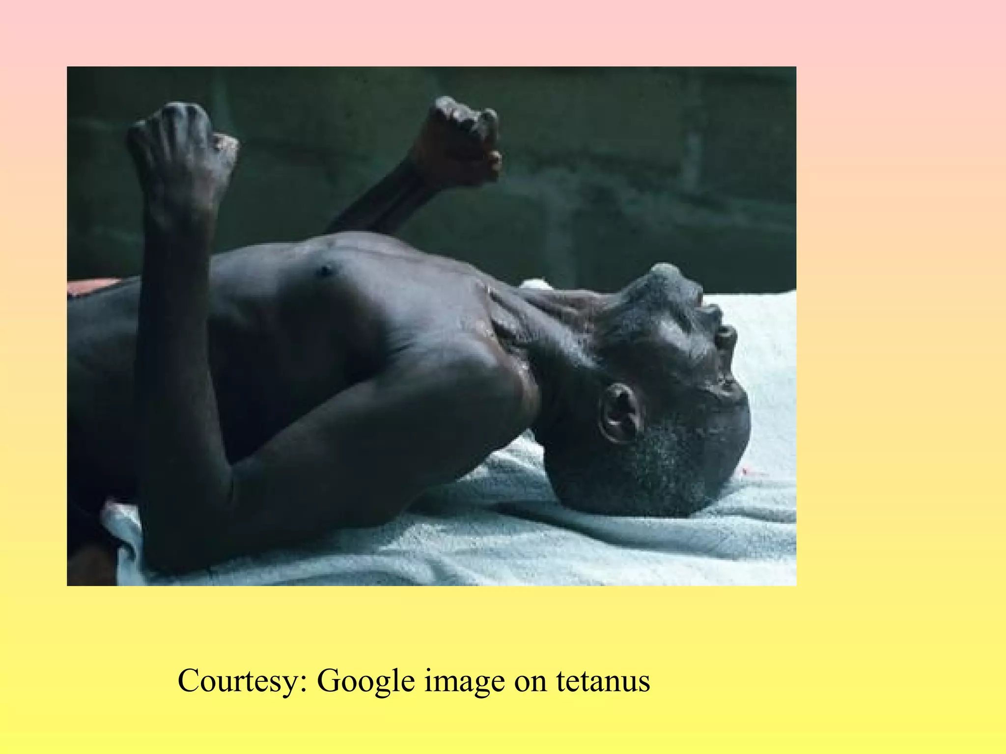 Courtesy: Google image on tetanus
 