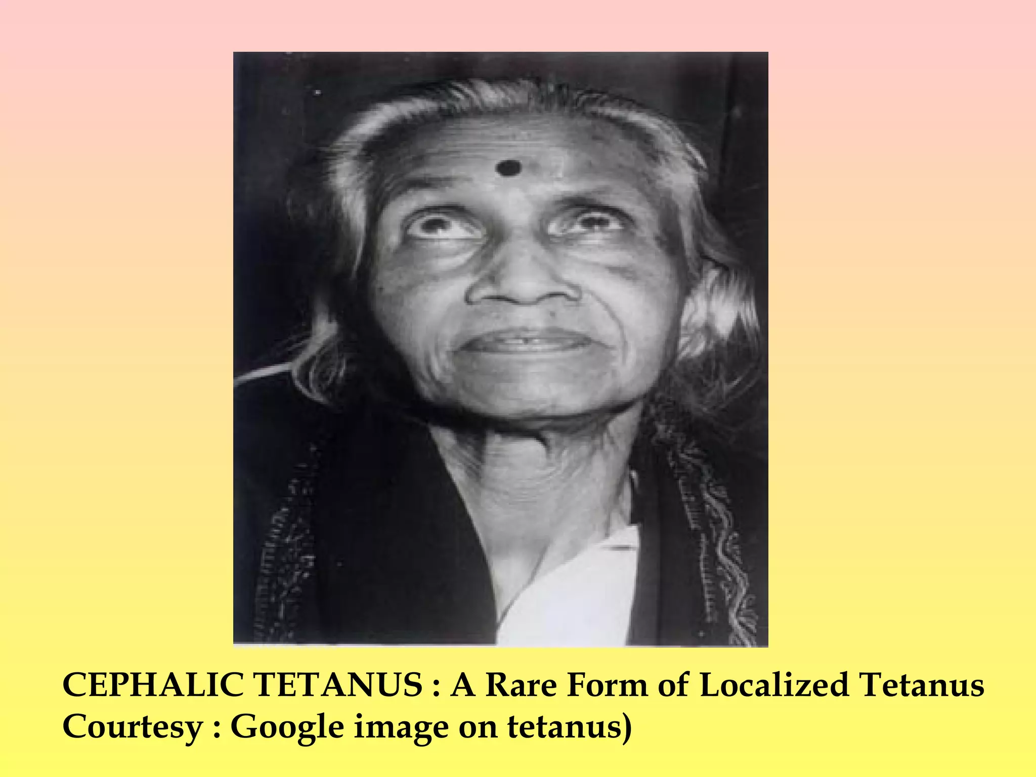 CEPHALIC TETANUS : A Rare Form of Localized Tetanus
Courtesy : Google image on tetanus)
 