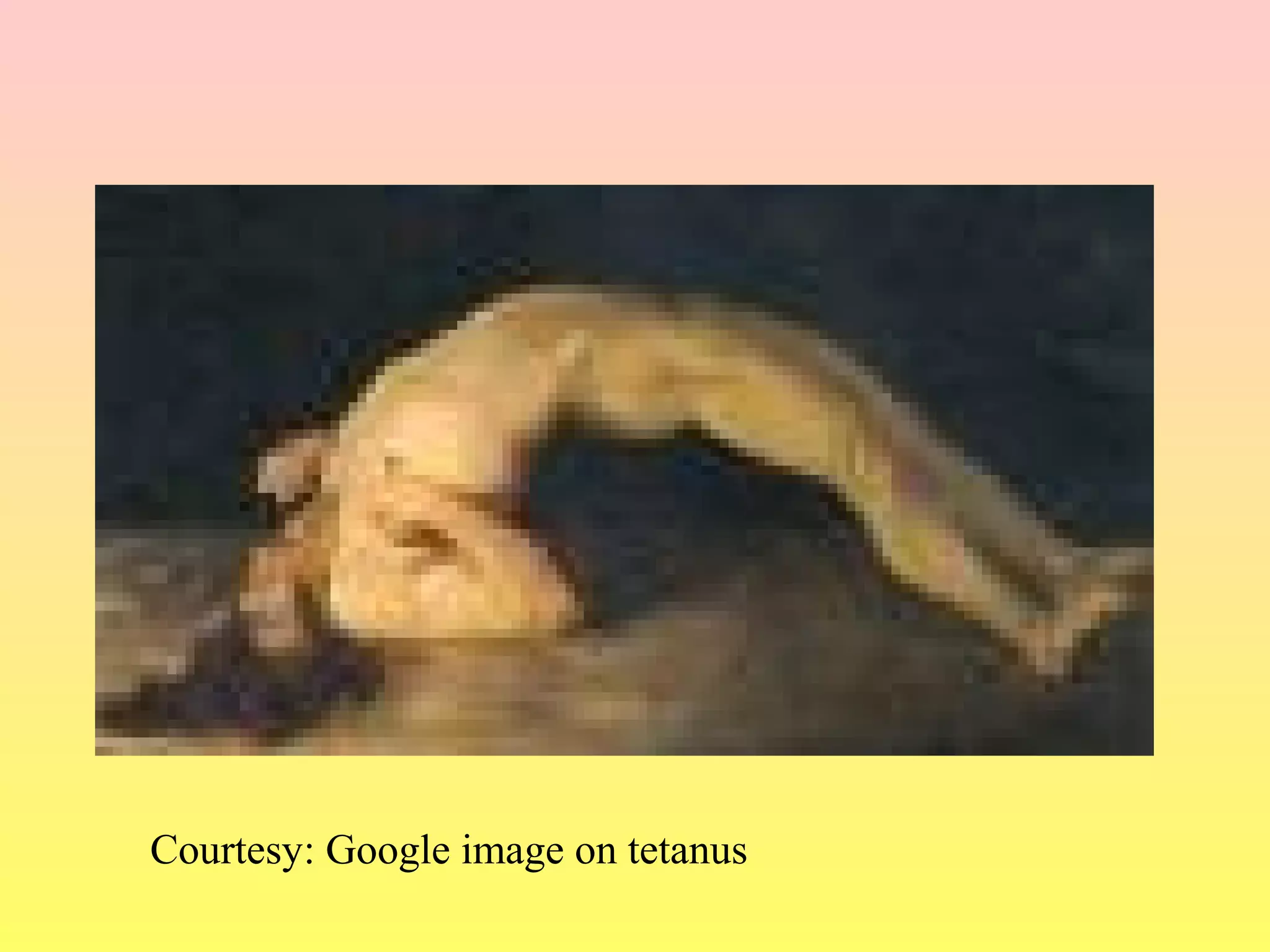 Courtesy: Google image on tetanus
 