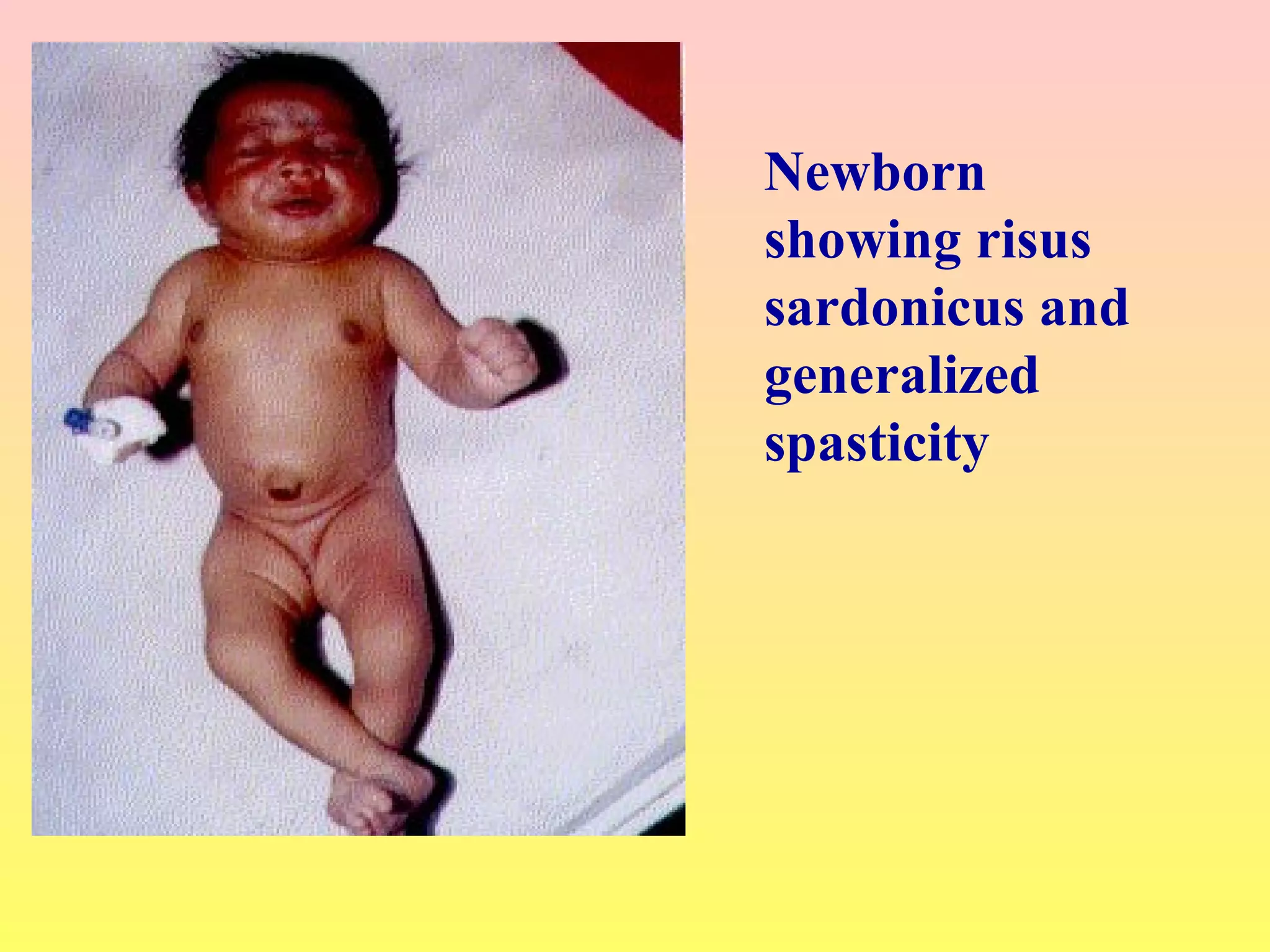 Newborn
showing risus
sardonicus and
generalized
spasticity
 