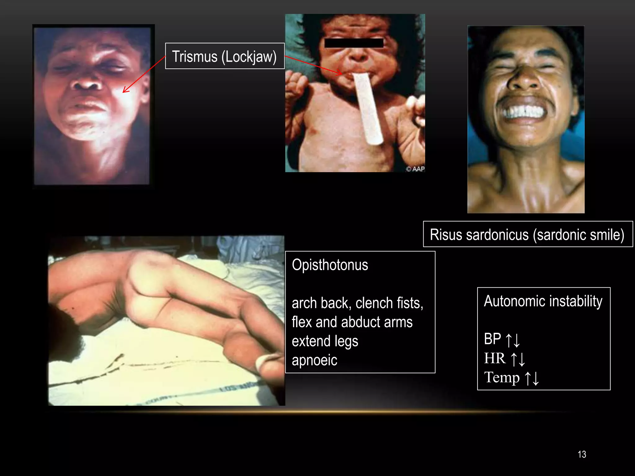 Trismus (Lockjaw)
Risus sardonicus (sardonic smile)
Opisthotonus
arch back, clench fists,
flex and abduct arms
extend legs
apnoeic
Autonomic instability
BP ↑↓
HR ↑↓
Temp ↑↓
13
 