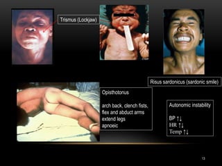 Trismus (Lockjaw)
Risus sardonicus (sardonic smile)
Opisthotonus
arch back, clench fists,
flex and abduct arms
extend legs
apnoeic
Autonomic instability
BP ↑↓
HR ↑↓
Temp ↑↓
13
 