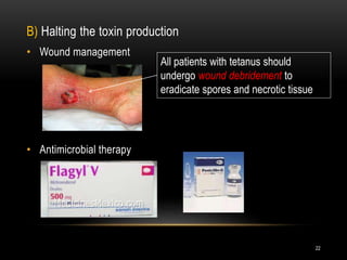 B) Halting the toxin production
• Wound management
• Antimicrobial therapy
All patients with tetanus should
undergo wound debridement to
eradicate spores and necrotic tissue
22
 