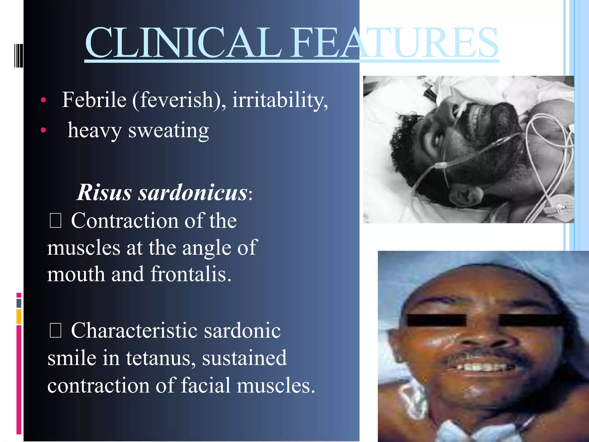 CLINICAL FEATURES
• Febrile (feverish), irritability,
heavy sweating•
Risus sardonicus:
Contraction of the
muscles at the angle of
mouth and frontalis.
Characteristic sardonic
smile in tetanus, sustained
contraction of facial muscles.
 