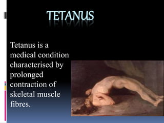 TETANUS
Tetanus is a
medical condition
characterised by
prolonged
contraction of
skeletal muscle
fibres.
 