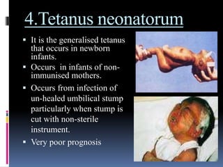 4.Tetanus neonatorum
 It is the generalised tetanus
that occurs in newborn
infants.
 Occurs in infants of non-
immunised mothers.
 Occurs from infection of
un-healed umbilical stump
particularly when stump is
cut with non-sterile
instrument.
 Very poor prognosis
 