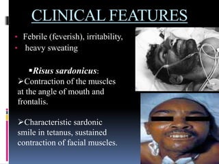 CLINICAL FEATURES
• Febrile (feverish), irritability,
• heavy sweating
Risus sardonicus:
Contraction of the muscles
at the angle of mouth and
frontalis.
Characteristic sardonic
smile in tetanus, sustained
contraction of facial muscles.
 