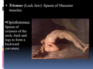  Trismus (Lock Jaw): Spasm of Masseter
muscles.
Opisthotonus:
Spasm of
extensor of the
neck, back and
legs to form a
backward
curvature.
 