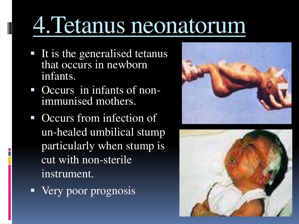 Tetanus