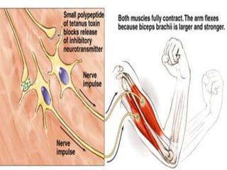 Tetanus Arm Example Tetanus | PPTX
