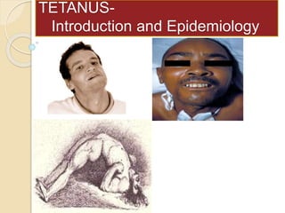 TETANUS-
Introduction and Epidemiology
 