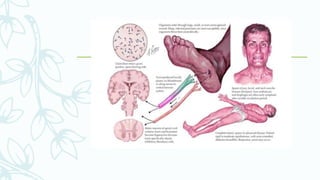 Tetanus | PPTX