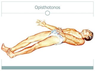 Opisthotonos
 