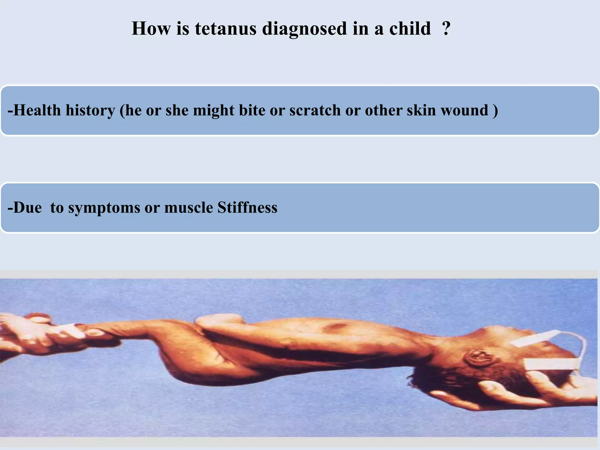 Tetanus Arm Example Tetanus.ppt