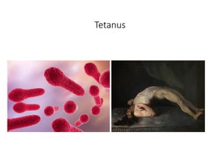 Tetanus Seizing Case and Topic presentation on Tetanus including management and ...