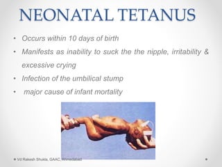 NEONATAL TETANUS
• Occurs within 10 days of birth
• Manifests as inability to suck the the nipple, irritability &
excessive crying
• Infection of the umbilical stump
• major cause of infant mortality
Vd Rakesh Shukla, GAAC, Ahmedabad
 