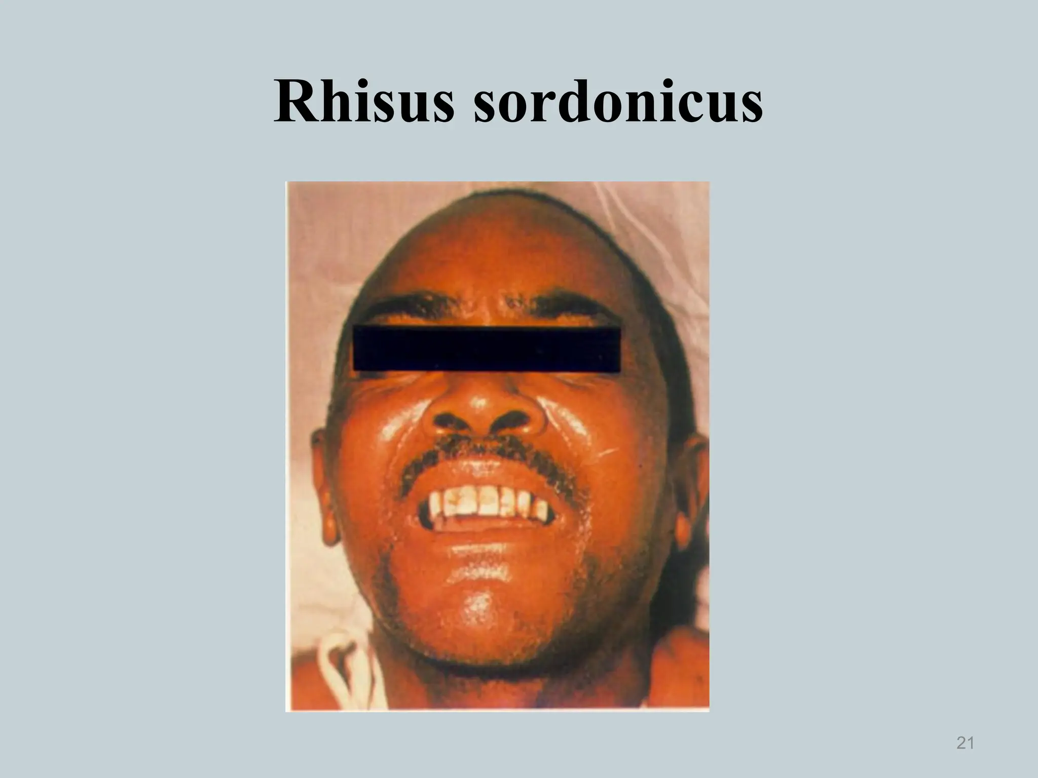Rhisus sordonicus
21
 