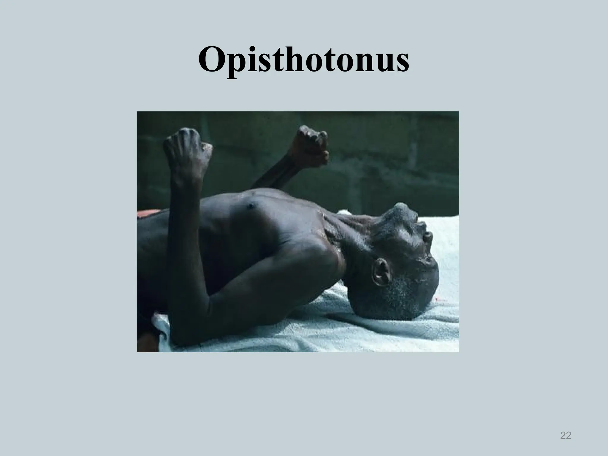 Opisthotonus
22
 