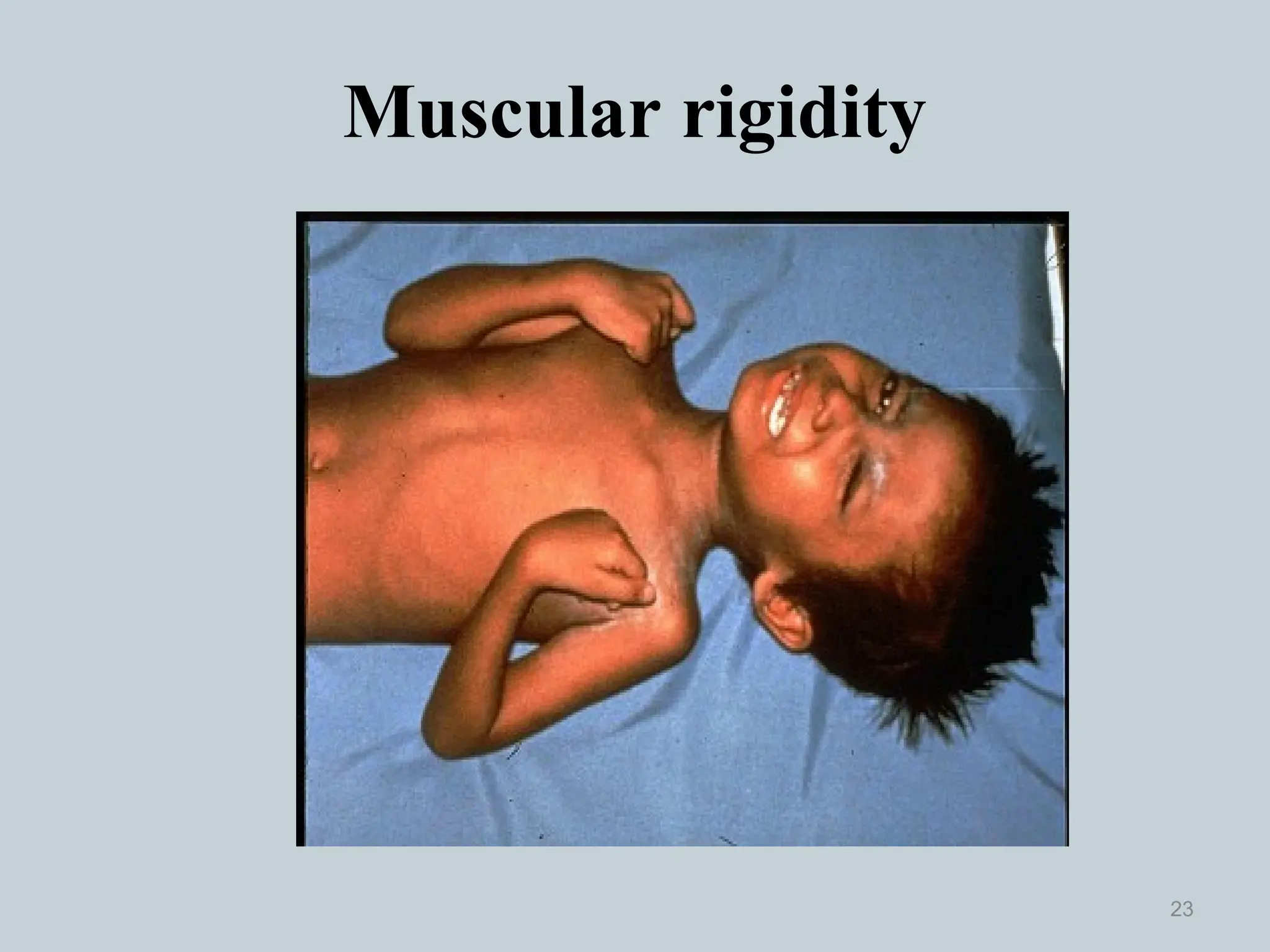 Muscular rigidity
23
 