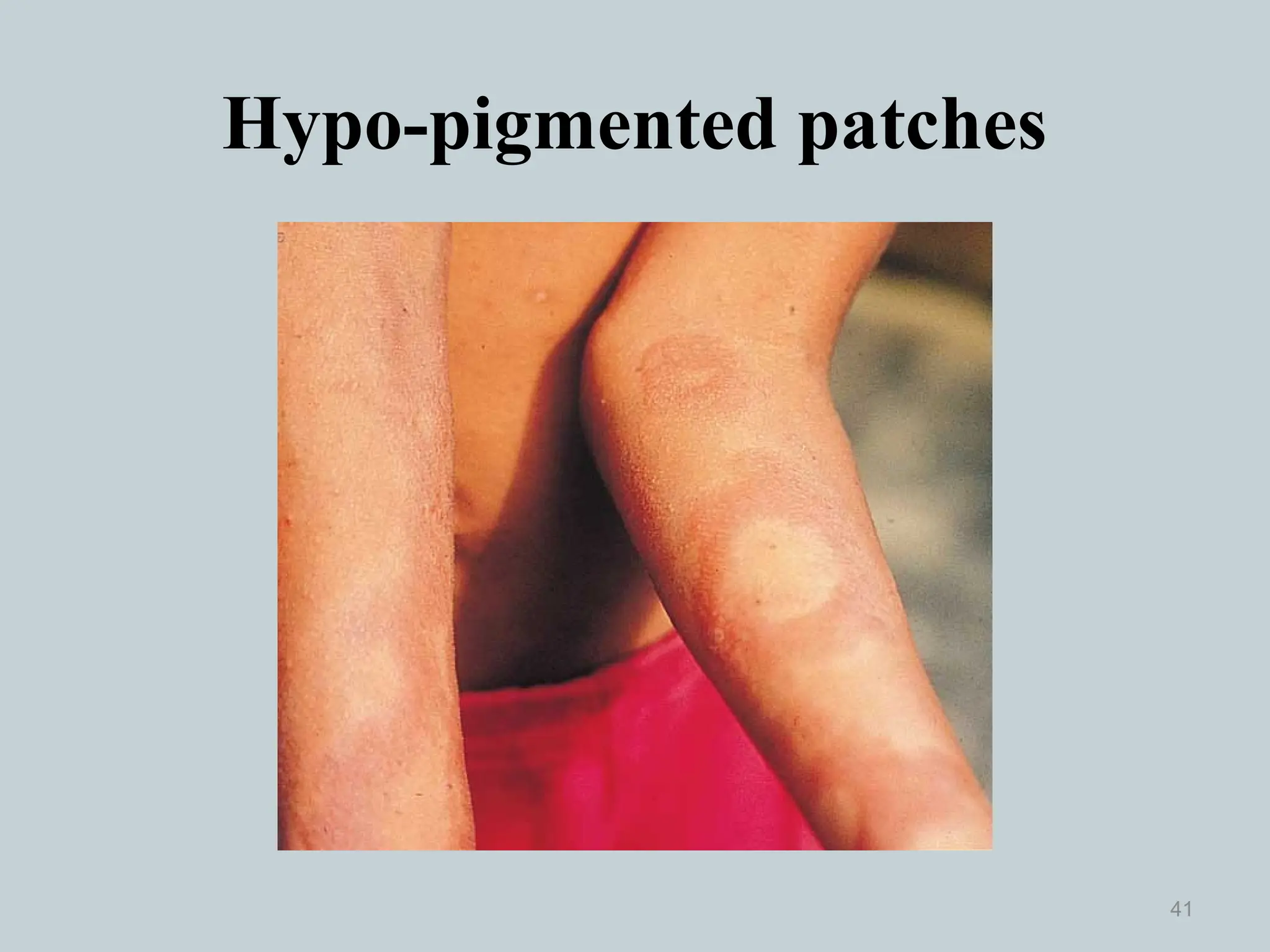 Hypo-pigmented patches
41
 