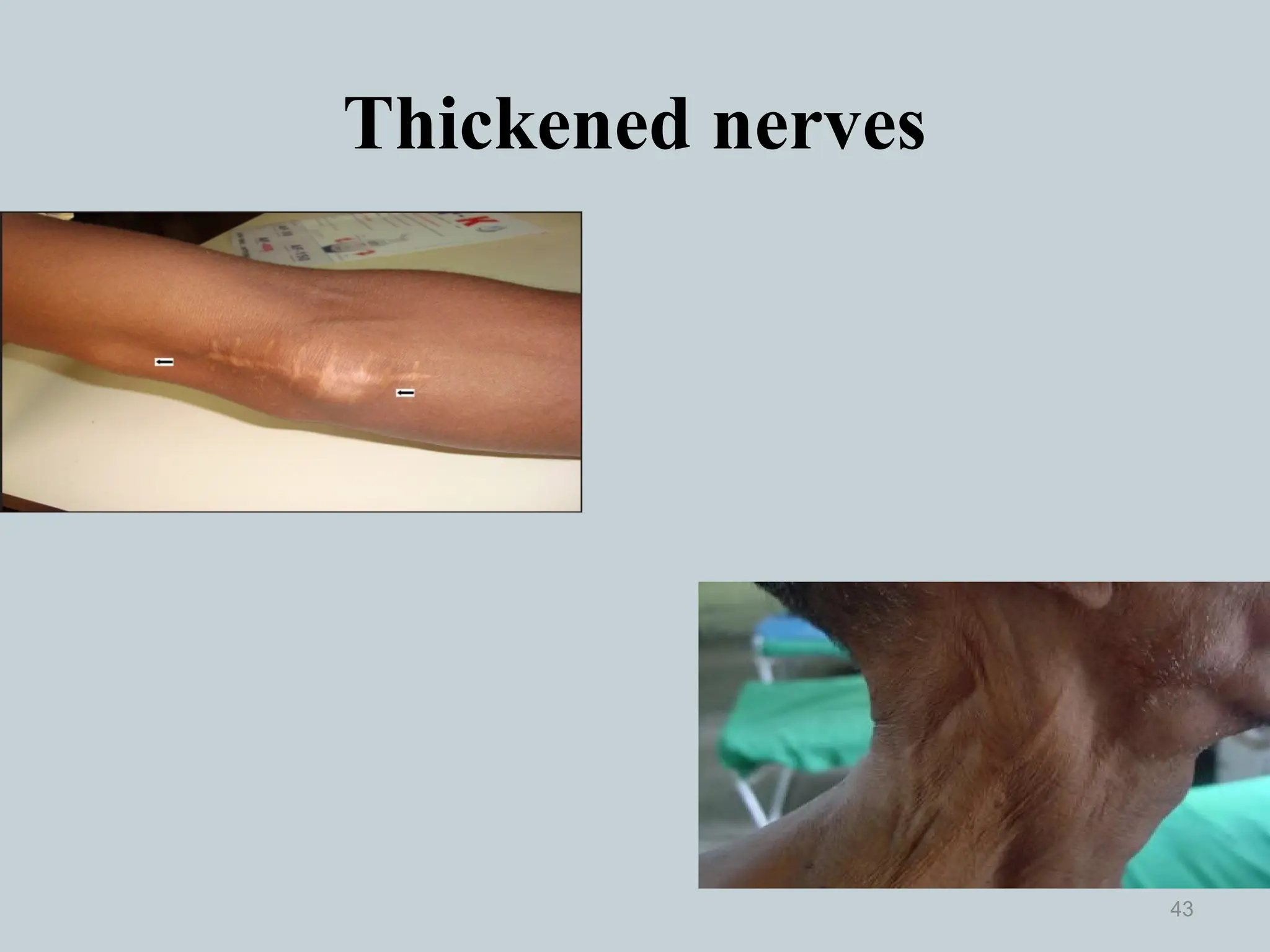 Thickened nerves
43
 