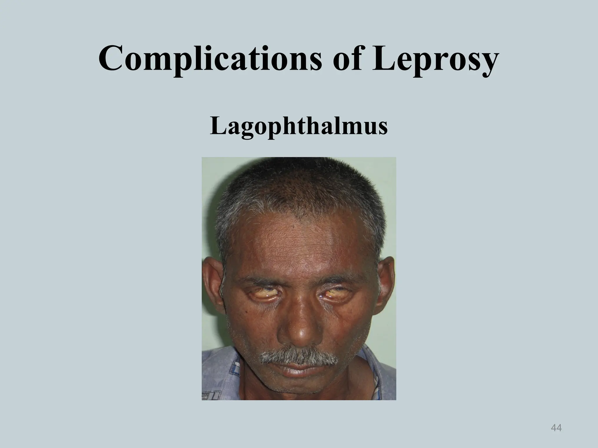 Complications of Leprosy
Lagophthalmus
44
 