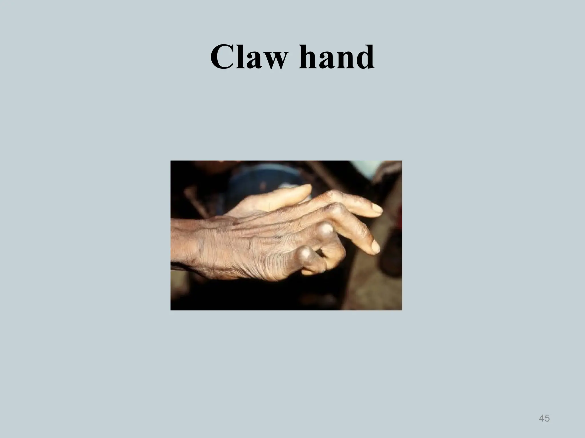 Claw hand
45
 
