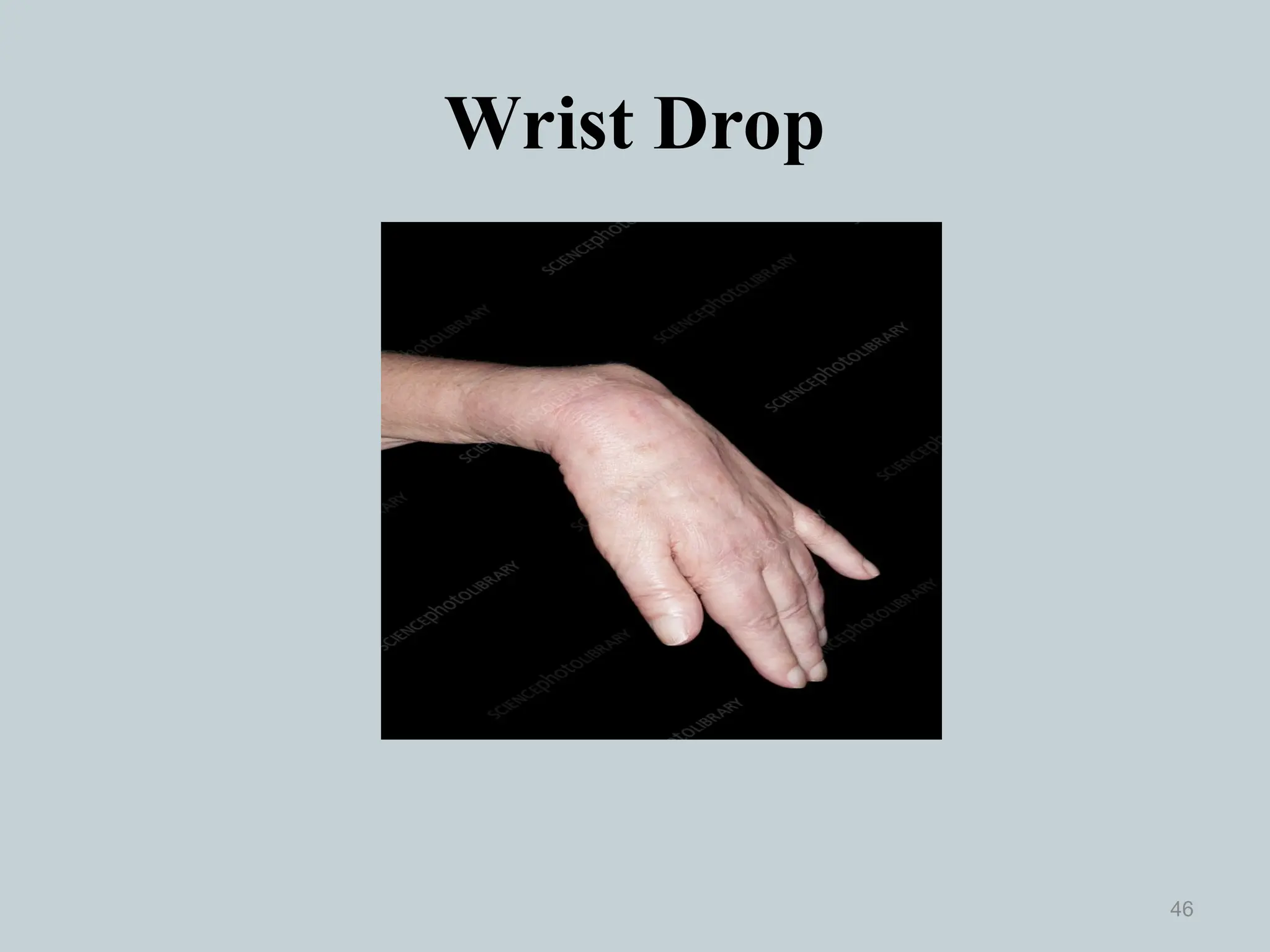 Wrist Drop
46
 
