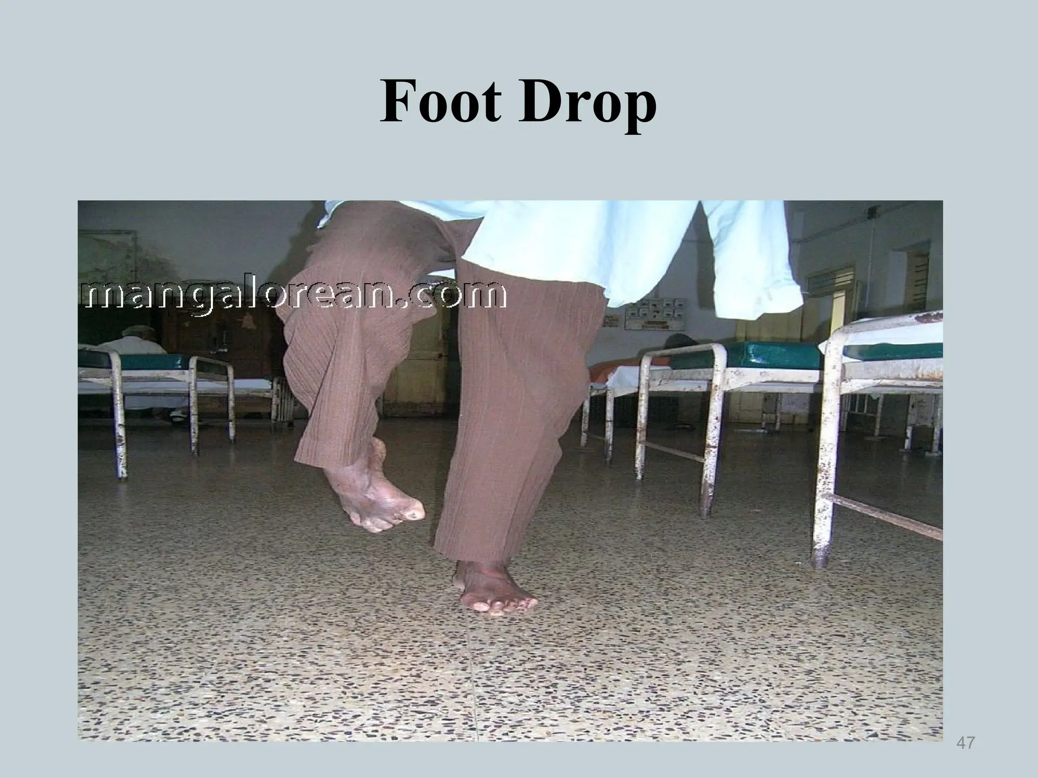 Foot Drop
47
 