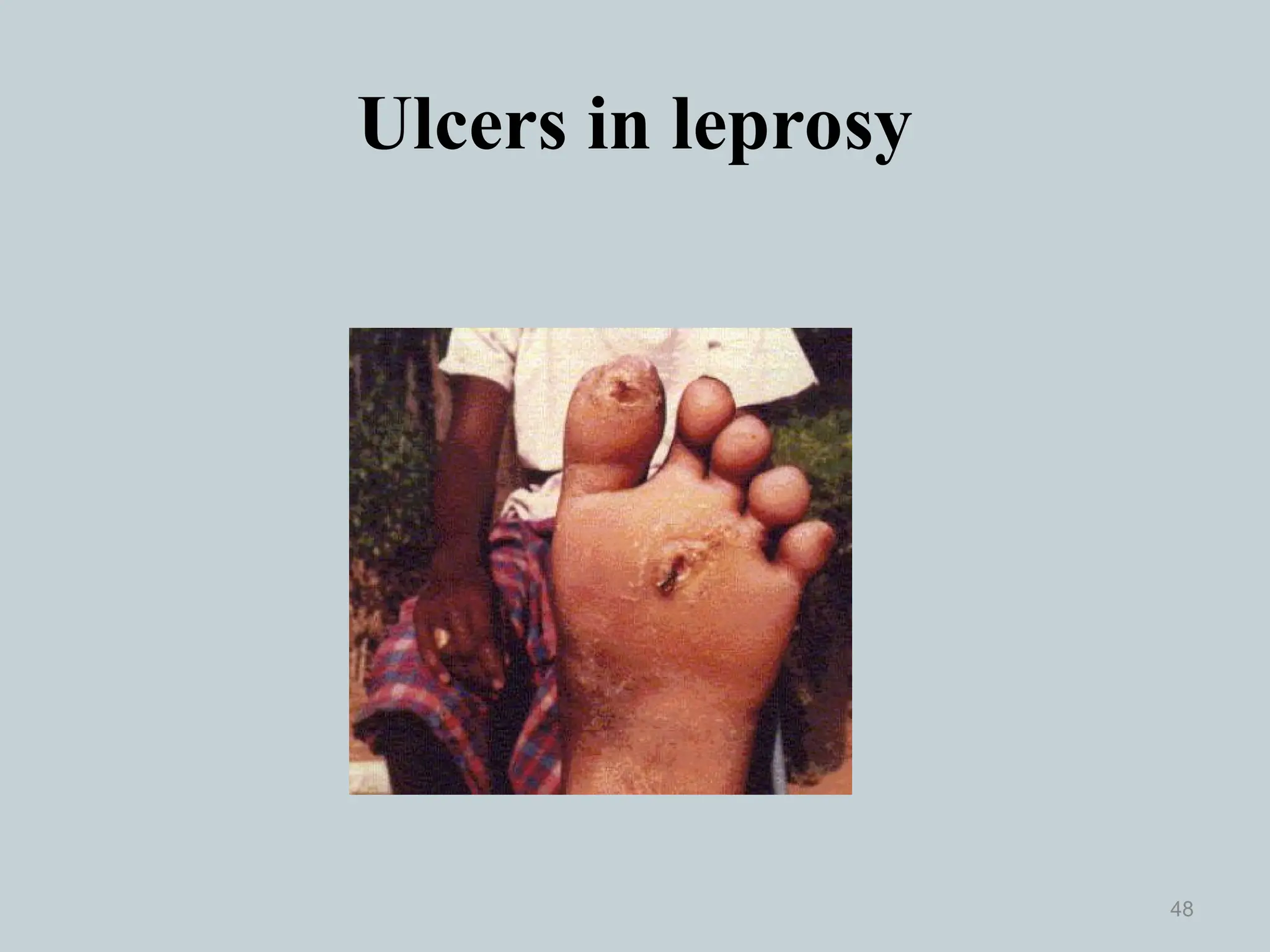Ulcers in leprosy
48
 