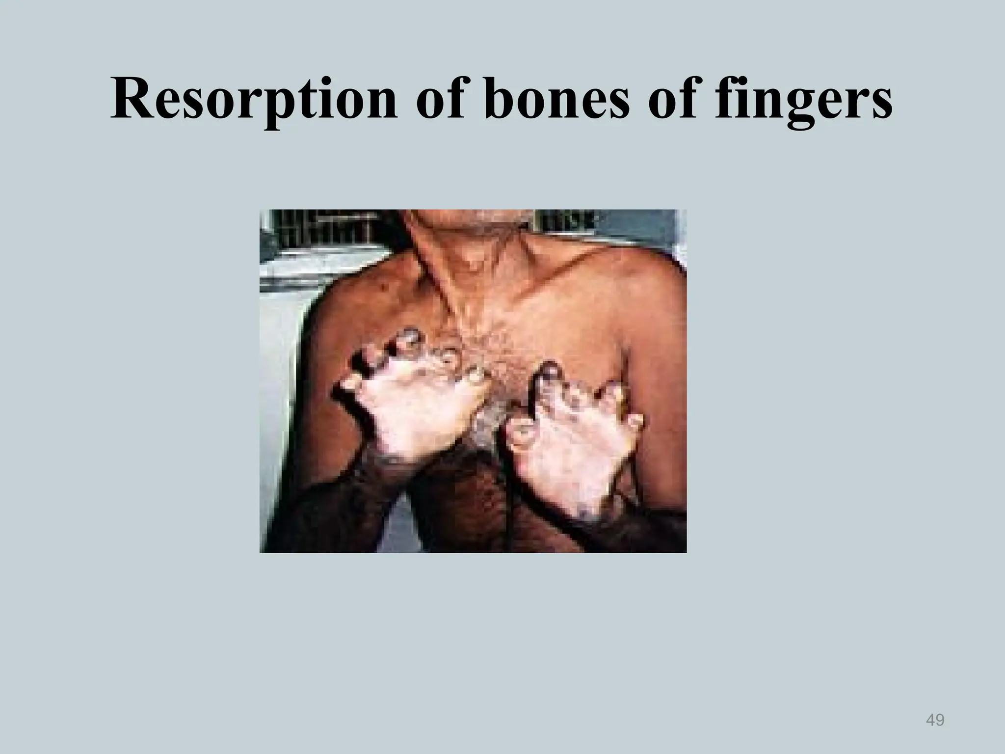 Resorption of bones of fingers
49
 